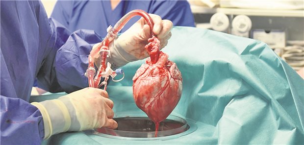 Bei einer Transplantation eines Schweineherzens wurde einem 57-Jährigen ein Schweinevirus übertragen. 