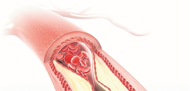 Bei familiärer Hypercholesterinämie treten kardiovaskuläre Ereignisse schon in jungen Jahren auf.