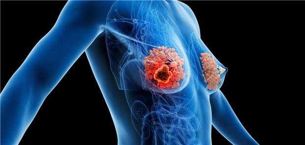 Brustkrebs Symbolbild