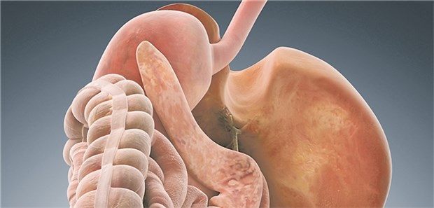 Prognose bei Dünndarm-GIST ähnlich wie bei Magen-GIST Bei gastrointestinalen Stromatumoren (GIST) im Dünndarm ging man bislang von einer schlechteren Prognose aus als bei gastrischen GIST.