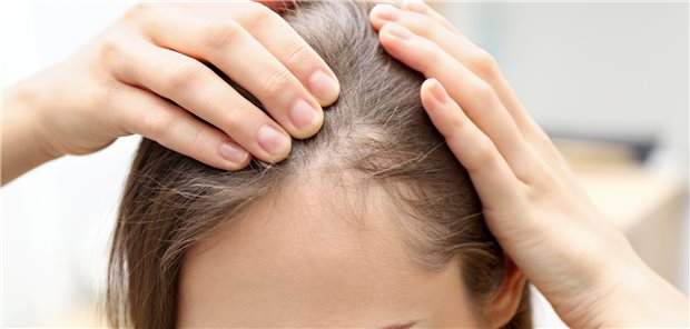 Bei gesteigertem Haarverlust nach einer COVID-Erkrankung handelt es sich wohl meist um ein telogenes Effluvium, seltener um eine Alopecia areata.

