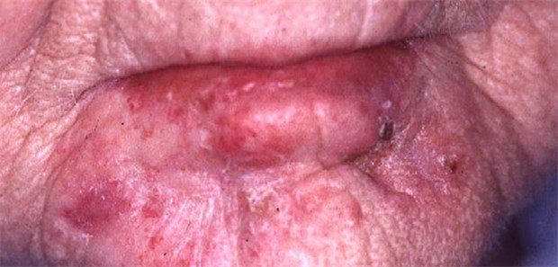 Kälte schlägt Laser Bei isolierten aktinischen Keratosen und geringer Lichtalterung empfiehlt sich die Kryotherapie.