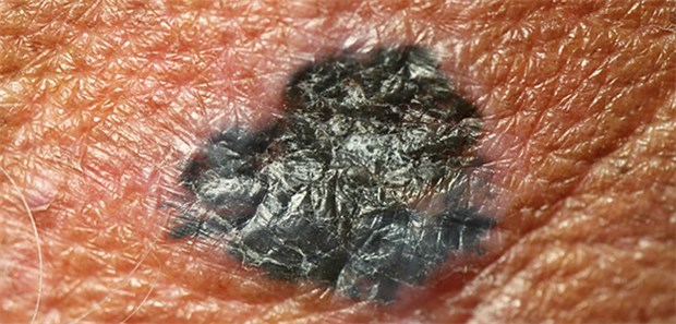 Bei kleinen Melanomen ist das Risiko, in Lymphknoten zu streuen, für jüngere Patienten merklich höher als für alte.