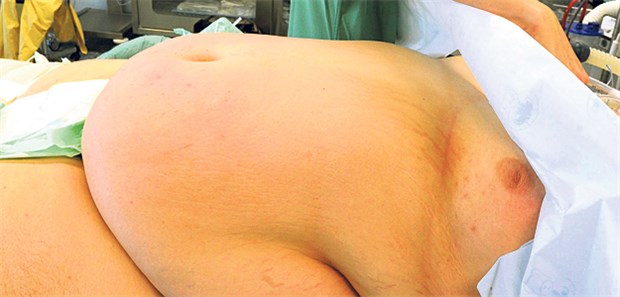 Große Hürden für stark Übergewichtige Bei krankhaftem Übergewicht auf den OP-Tisch: Für viele adipöse Patienten der einzige Weg zur dauerhaften Gewichtsreduktion.
