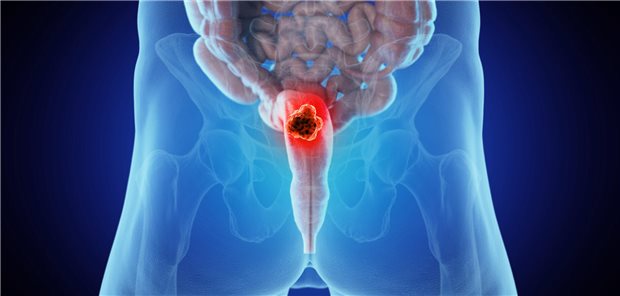 Bei lokal nicht fortgeschrittenen Rektumkarzinomen ist eine neoadjuvante Kurzzeitbestrahlung häufig überflüssig, offenbart eine niederländische Studie.

