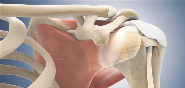 Bei mechanischem Konflikt unter dem Schulterdach kann eine Op indiziert sein.