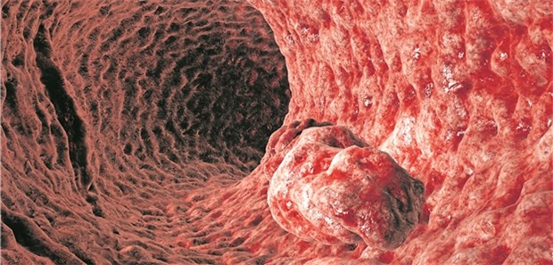 Bei mehr als drei Adenomen in der Koloskopie gelten Patienten in Deutschland als Risikokandidaten.