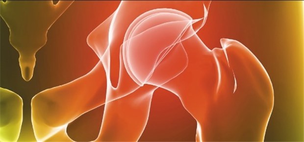 Was bringen langsam wirkende Arthrose-Mittel? Bei milder Hüftarthrose ist Chondroitin-Effekt unklar.
