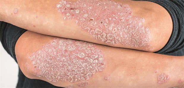 Psoriasis-Plaques auf den Unterarmen eines Mannes.