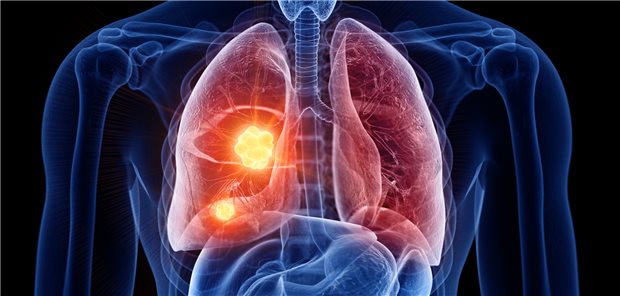 Bei nicht-kleinzelligem Lungenkrebs könnte sich eine Bestrahlung in Kombination mit einer Immuntherapie lohnen. Das lassen erste Ergebnisse einer Phase-I-Studie vermuten.