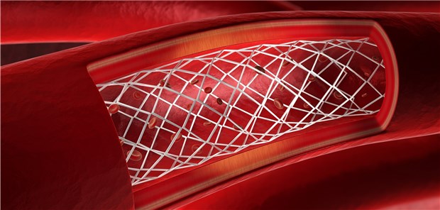 So oft verursachen Stents Spätfolgen Bei rund zwei Prozent aller Stent-Patienten kommt es innerhalb von fünf Jahren zu späten ischämischen Ereignissen.