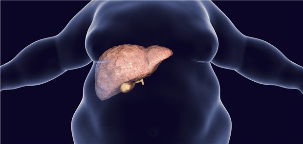 Bei starkem Übergewicht und Diabetes wird bisher nicht systematisch auf Fettleber gescreent.