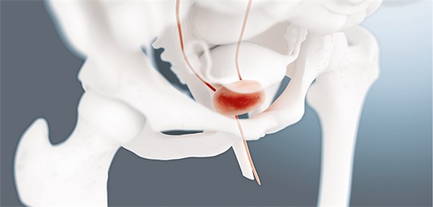 Bei überaktiver Blase werden auch neurogene und muskuläre Veränderungen als Ursachen diskutiert.