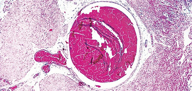 Wie lange macht die Antikoagulation Sinn? Bei venösen Thrombembolien erhöhen Residuen das Risiko für erneute tiefe Venenthrombosen.