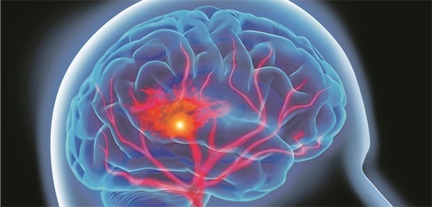 Oft fehlt die Antikoagulation Bei zwei Drittel der untersuchten Schlaganfall-Patienten unter VKA-Therapie war der INR zu niedrig.