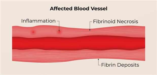 Abbildung eines durch eine ANCA-Vaskulitis beeinträchtigtes Blutgefäß. Es sind Entzündungsherde, fibrinoide Nekrosen und Fibrinablagerungen sind in der Wand des Blutgefäßes zu sehen.