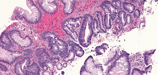 Histologisches Präparat eines Barrett-Ösophagus