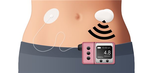 Beim „Closed-Loop“ drosselt oder steigert die Pumpe die Insulinfreisetzung automatisch anhand der kontinuierlich gemessenen Glukosewerte.