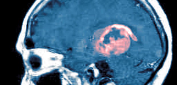 Der Tumorgrad bestimmt die Therapie Beim Gliom erfordern Langzeitdaten großer Studien nun neue Therapiestrategien.