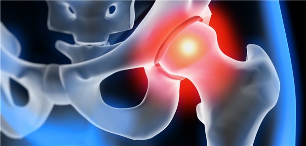 Beim Hüftimpingement kommt es zum abnormen Kontakt zwischen Femur und Hüftpfanne.