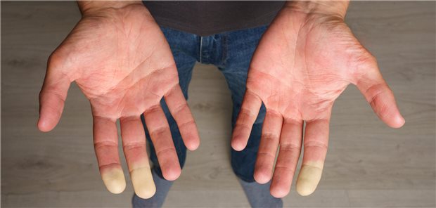 Blick auf die Hände eines Mannes mit Farbveränderungen an mehreren Fingerkuppen