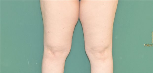 Ein Lipödem im Stadium 1. 