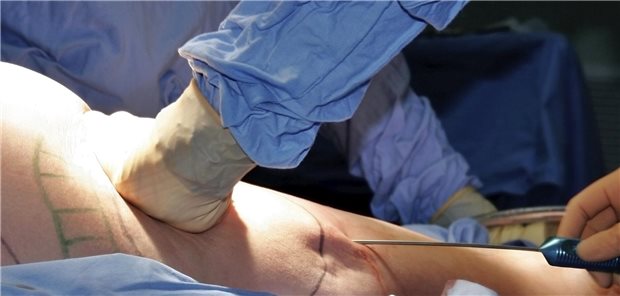 Operative Fettabsaugung