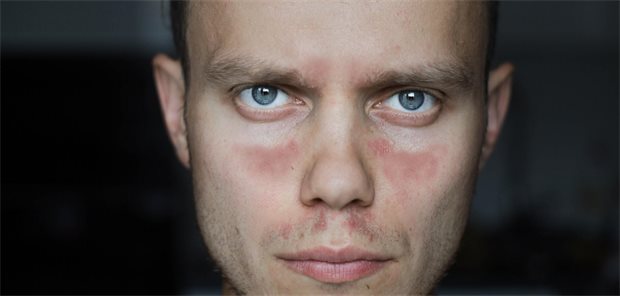 Das Gesicht eines Mannes mit Lupus erythematodes, der typische rote Flecken unter den Augen hat.