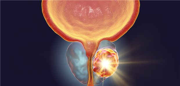 Abbildung Prostatakarzinom