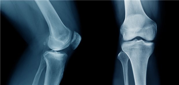 Beim Röntgen des Knies eines Patienten mit Knieschmerzen fanden die Ärzte ein Souvenir einer früheren Op. (Symbolbild)