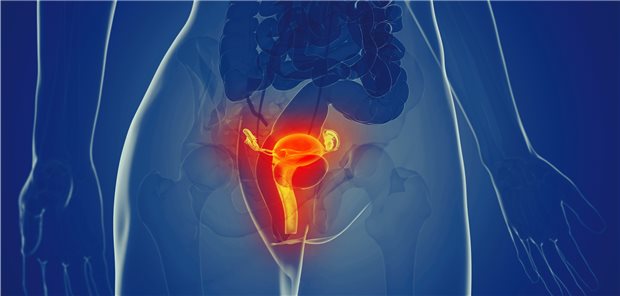 Beim Zervixkarzinom im Frühstadium hat sich die laparoskopische und robotergestützte minimalinvasive Hysterektomie in den vergangenen 25 Jahren als Standardtherapie etabliert.