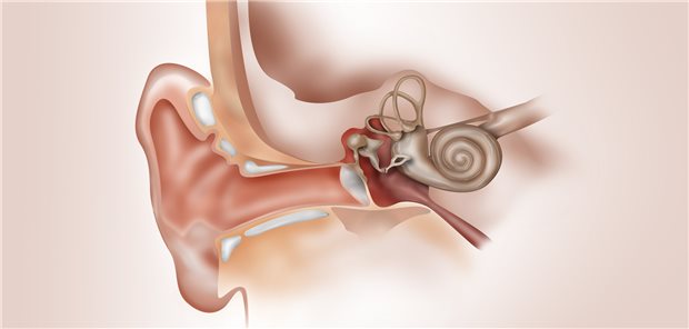 Beim benignen Lagerungsschwindel reizen Steinchen (Canalolithiasis) die Sensorzellen in den Bogengängen des Innenohrs und lösen so den Vertigo aus.
