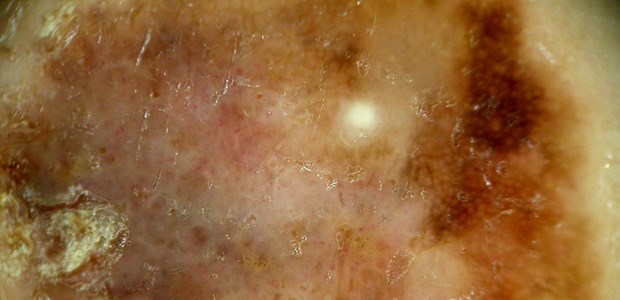 Beim malignen Melanom setzen Experten zunehmend auf die Immuntherapie.