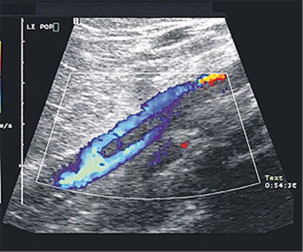 Edoxaban macht VTE-Prophylaxe sicherer Beinvenenthrombose im Farbdoppler: Der Thrombus wird fast zirkulär umflossen.
