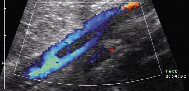 Nicht mehr als ein Verdacht Beinvenenthrombose im Farbdoppler: Der Thrombus wird fast zirkulär umflossen.