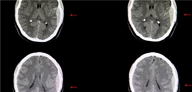 Beispiel einer Hirnblutung, hier bei einem Opfer eines Verkehrsunfalls. Im CT-Scan ist eine große epidurale Blutung in der linken zerebralen Hemispähre zu sehen.