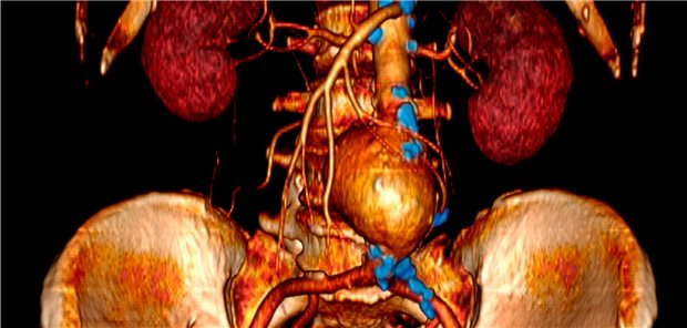 Beispiel eines großen Bauchaortenaneurysmas (Mitte) in der CT-Angiographie. Die in der vorliegenden Studie untersuchten Aneurysmen waren kleiner. Außerdem auf dem Bild zu erkennen: Verkalkungen (in blau), die auf Atherosklerose hindeuten.