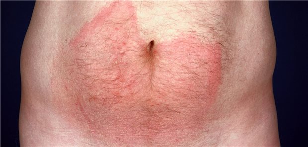 Beispiel von Wanderröte (erythema migrans)