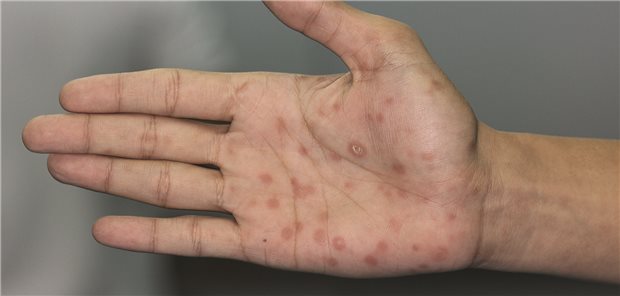 Neuer Höchststand: Über 9.500 Syphilis-Fälle 2024 gemeldet Eine Hand mit dem bekannten Syphilis-Ausschlag.