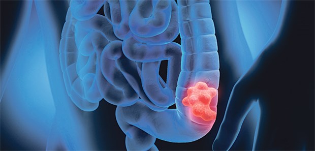 Mit Sport vor der Diagnose bessere Prognose Bereits 30 bis 60 Minuten tägliche moderate körperliche Aktivität gingen in Studien mit einem verringerten Darmkrebsrisiko einher.