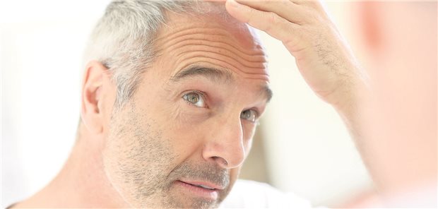 Post-Finasterid-Syndrom – ein Nocebo-Effekt? Besorgt, weil die Haare auf dem Kopf weniger werden? Menschen, die sich wegen androgenetischer Alopezie in medizinische Behandlung begeben, beobachteten den eigenen Körper sehr stark, meint ein Kollege beim europäischen Derma-Kongress. (Symbolbild mit Fotomodell)
