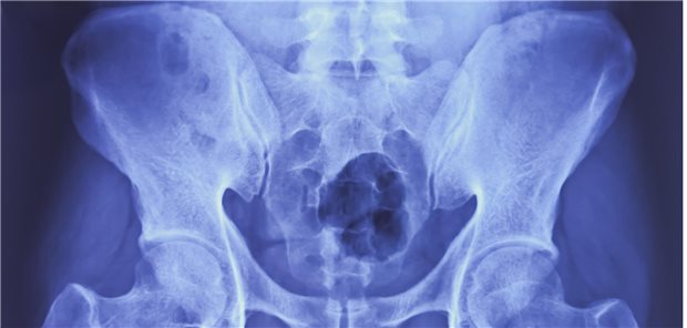 Beste Vorhersagekraft im Hinblick auf die Unterscheidung zwischen ‚definitiv axSpA‘ und ‚definitiv keine axSpA‘ nach zwei Jahren waren der Nachweis von HLA B27 und der Ausgangsbefund einer Sakroiliitis. (Symbolbild)