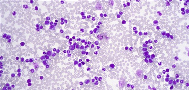 Besteht neben der HIV-Infektion eine hämatologische, für eine Stammzelltransplantation indizierte Erkrankung, wie eine AML-Erkrankung (Blutausstrich), hat die Patientin oder der Patient die Chance auf eine Heilung durch die Stammzelltransplantation. Die Forschung arbeitet daran, dass auch nicht hämatologisch erkrankte HIV-Patienten geheilt werden können.