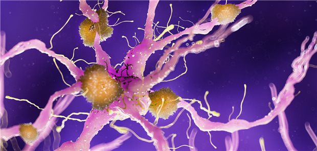 Gantenerumab bei frühem Alzheimer: Primäre Endpunkte nicht erreicht Beta-Amyloid-Plaques (gelb) lagern sich an Nervenzellen (rosa) an. Die potentiellen Folgen: Zerstörung der Nervenzelle und Manifestation einer Alzheimer Erkrankung. (3D-Illustration)