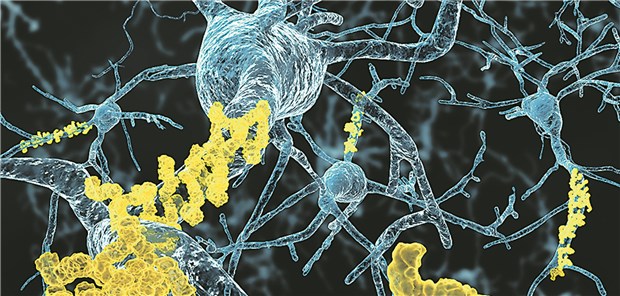 Beta-Amyloid bei Morbus Alzheimer: Trigger oder Marker?