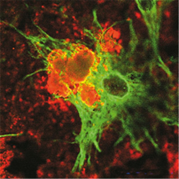 Alzheimer durch Insulinresistenz im Gehirn? Beta-Amyloid (orange) wird von Astrozyten (grün) vertilgt.