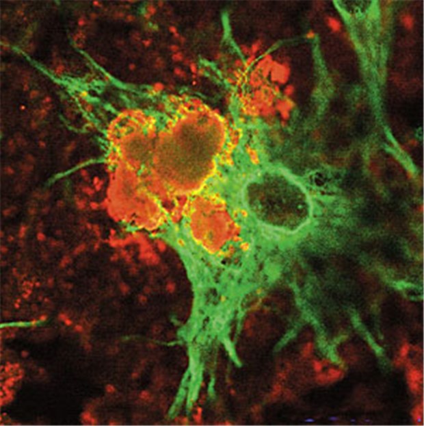 Vitamin B12 beugt möglicherweise Alzheimer vor Beta-Amyloid (orange) wird von Astrozyten (grün) vertilgt.