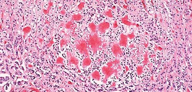 Alzheimer-Peptid stoppt MS Beta-Amyloidablagerungen: Im Tiermodell wirksam gegen MS.