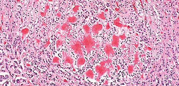 Neuer Weg im Kampf gegen Alzheimer Beta-Amyloidablagerungen bei Alzheimer: Sie gilt es zu verhindern.