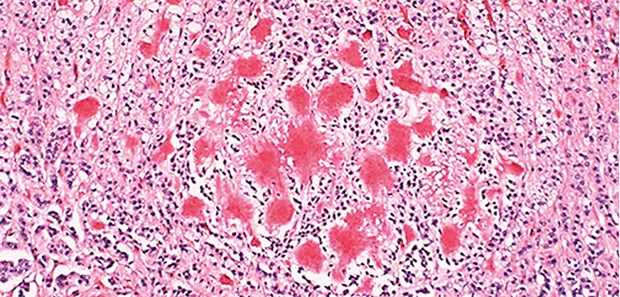 Beta-Amyloidablagerungen im Hirn bei Alzheimer.